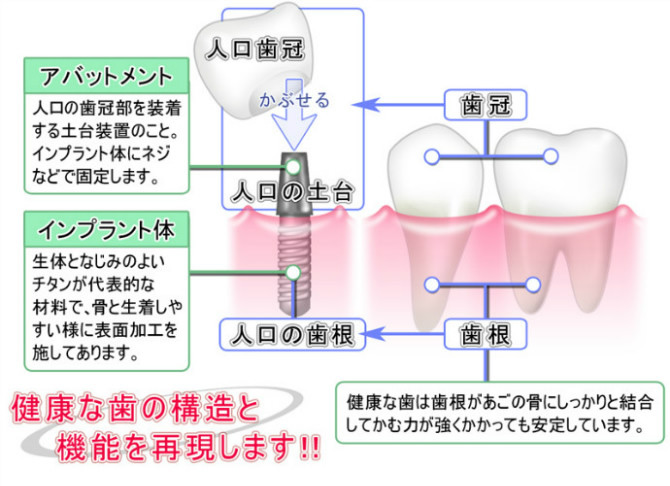 インプラントとは？